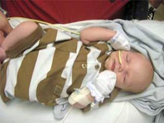 One-month-old Mason Garka is receiving treatment for hypoplastic left heart syndrome